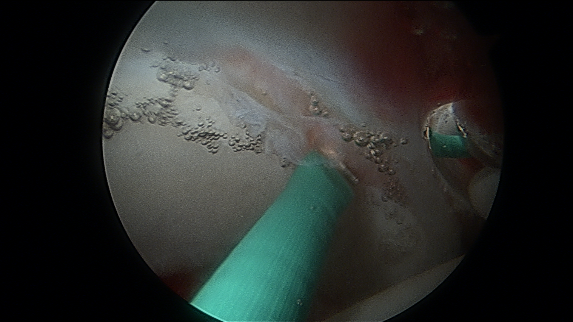 Hip Arthroscopy labral tear